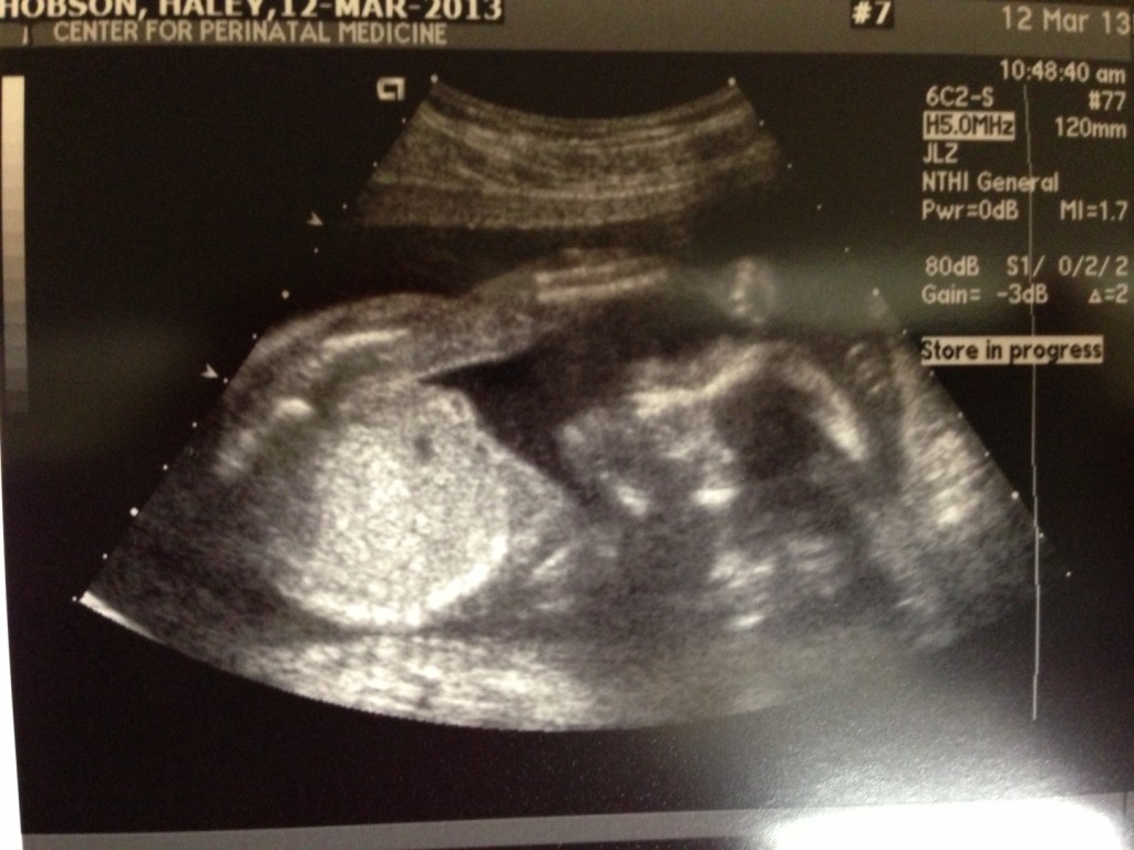 ultrasound at 20 weeks