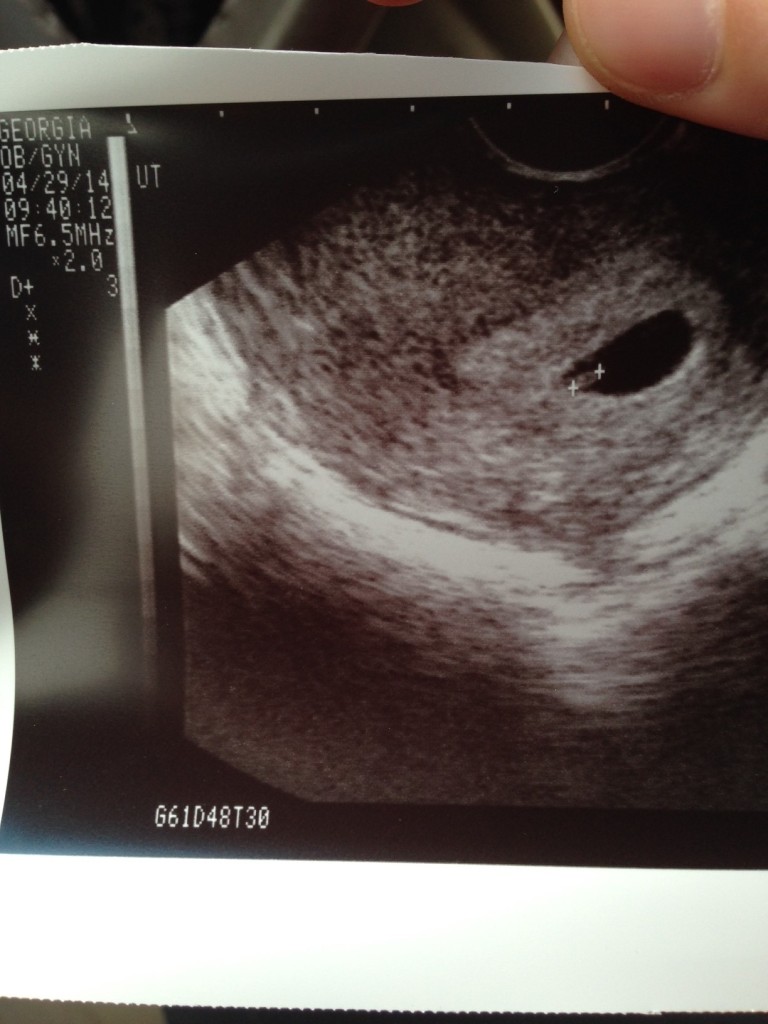 nursing and fertility 6 week ultrasound