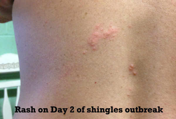 shingles in your 30s thirties, shingles rash