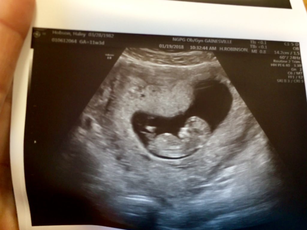 sonogram 11 weeks, baby #4