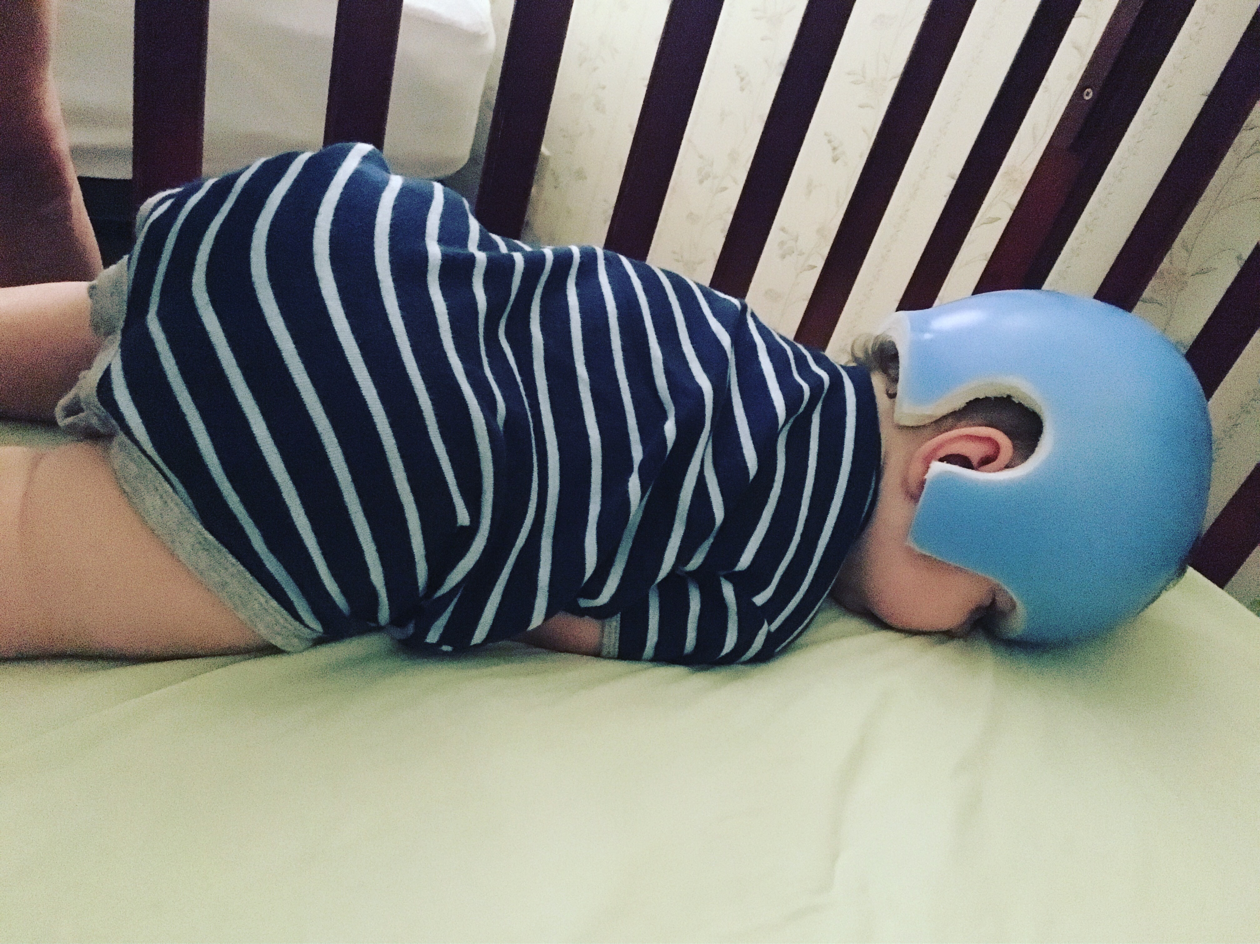 Plagiocephaly and a baby helmet sleeping
