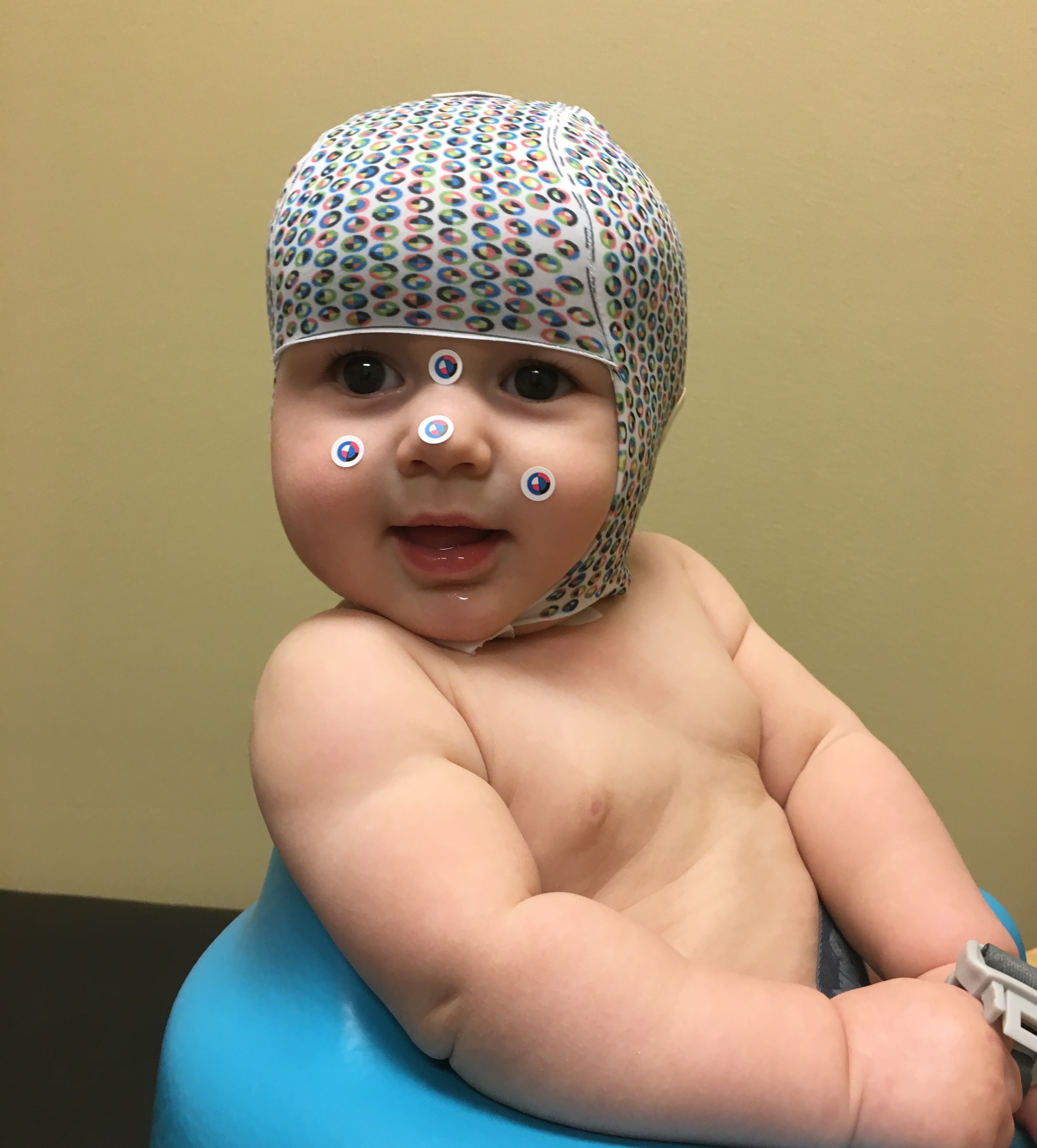 Plagiocephaly and a baby helmet measurement