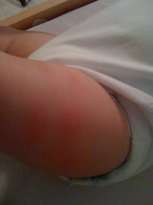 mosquito bites on baby