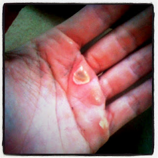 hand rips from pullups