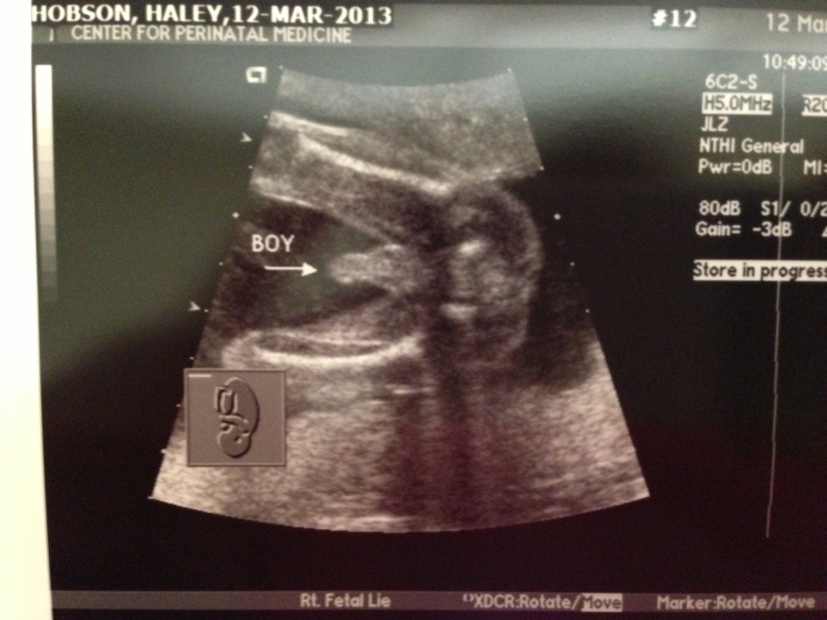 baby at 20 weeks